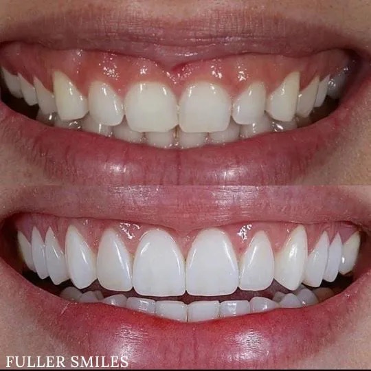 The image shows a close-up of a person s smile with white teeth and gums, presented in three different views  from the front, side, and top.
