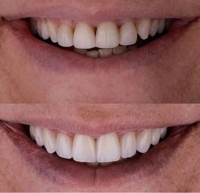The image displays a person s smiling mouth with teeth showing, presented from different angles in four separate photos.