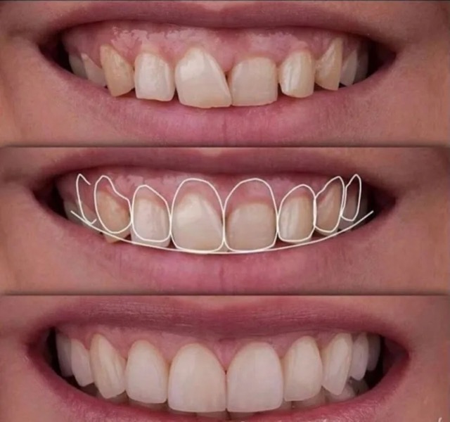 The image shows a series of four photographs of a person s teeth with progressively more severe dental problems, from yellowing to a full set of braces and orthodontic work.