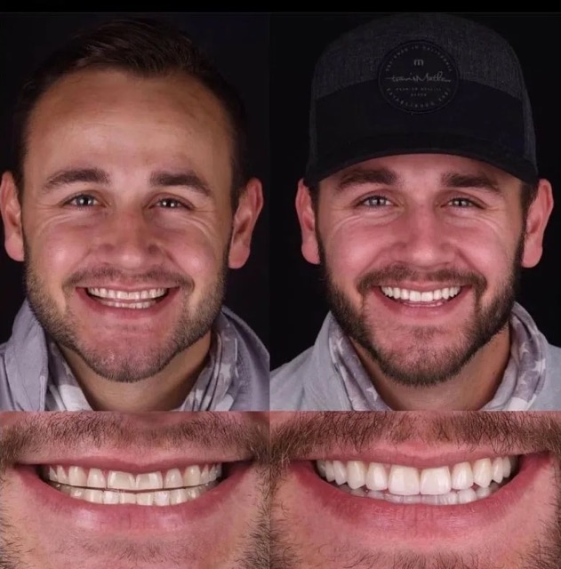 The image displays a man with a beard smiling, showcasing a set of teeth and facial hair, with two different versions of his smile presented side by side for comparison.
