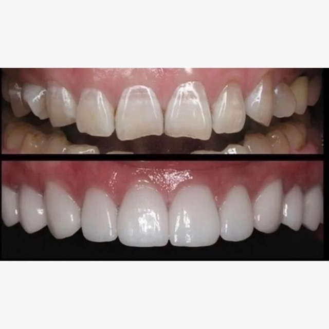 The image shows two close-up photographs of teeth with varying shades of discoloration, displayed side by side against a black background.