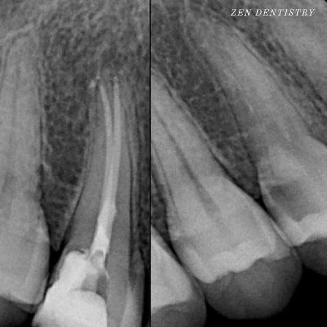 The image shows a close-up view of a dental X-ray with an overlay of a split image comparison, revealing a significant difference between two states of dental health, emphasizing the importance of oral hygiene.