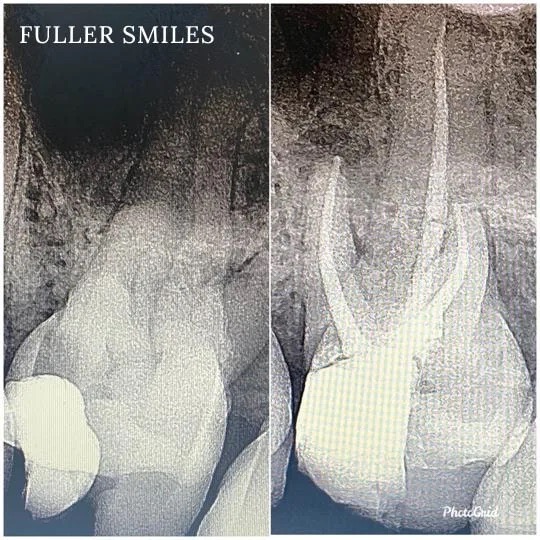 The image shows a set of dental X-rays with annotations indicating the presence of 'fuller smiles' on two of them, and one X-ray has an additional annotation for a 'root canal.