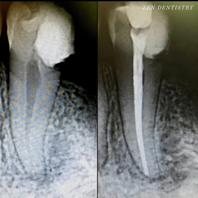 The image shows two side-by-side photographs of a dental X-ray with a focus on an implant and a tooth, highlighting the difference between a natural tooth and a dental implant.