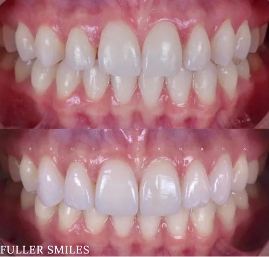 The image displays a before-and-after comparison of dental implants with a focus on the transformation of a smile, showcasing a set of full teeth and a close-up view of the final result.