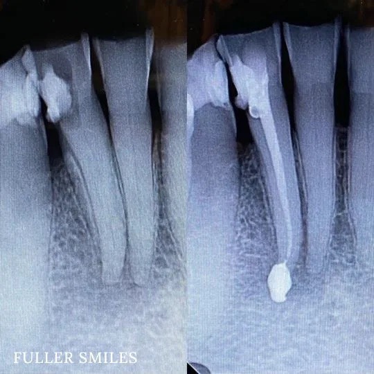 The image displays three close-up photographs of dental X-rays with different parts of teeth highlighted, showing various stages of dental work such as fillings, crowns, and tooth extraction.