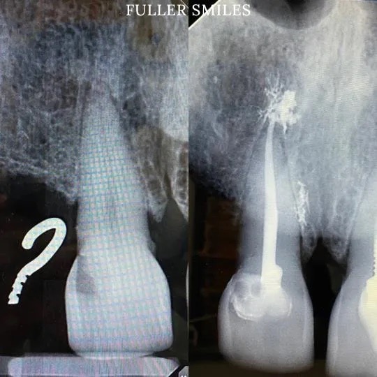 The image shows a dental X-ray with two views of a tooth, one from the front and one from the side, highlighting an area of decay or damage.