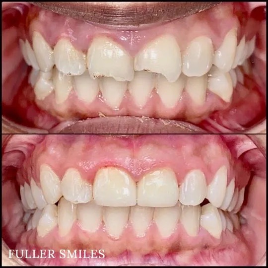 The image displays four photographs of a person s teeth showing varying stages of dental treatment, from natural to full cosmetic makeover with an overlay text stating  FULLER SMILES.