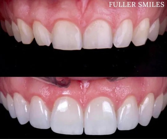 The image shows a pair of full dentures with a close-up view of the upper teeth.