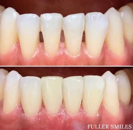 The image shows a close-up of a person s teeth with a focus on cosmetic dental work, specifically a set of veneers or dental implants that appear to be a lighter shade than the surrounding natural teeth.