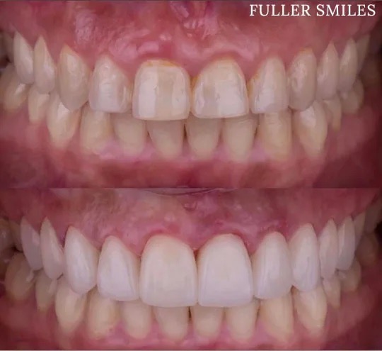 The image shows a close-up of a person s teeth with a focus on dental care, specifically highlighting the effects of fuller smiles.