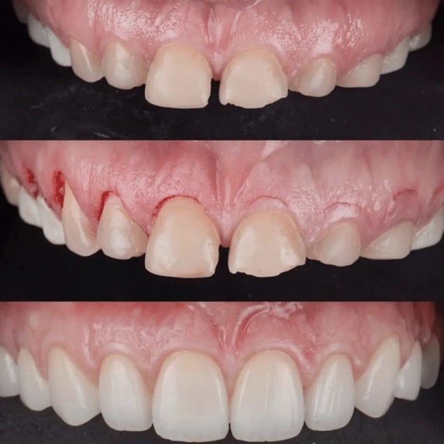 The image shows a series of photographs featuring a set of teeth with visible signs of decay and damage, including discoloration and missing enamel, against a dark background.