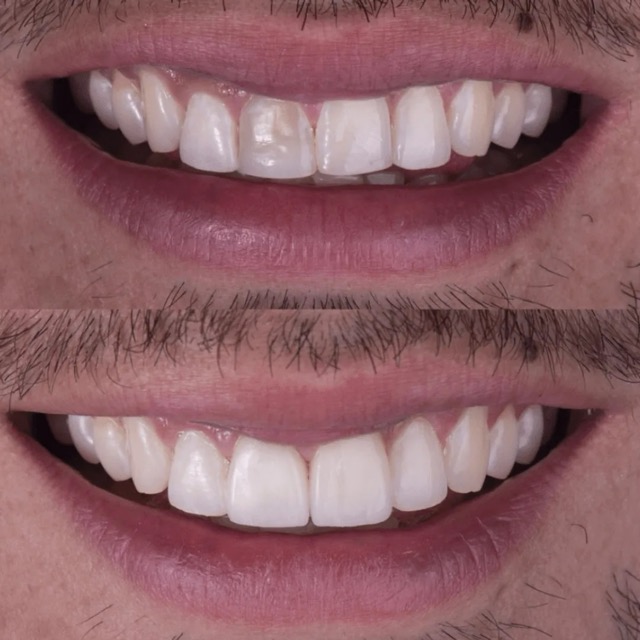 The image shows two close-up photos of a person smiling with their teeth, displaying a wide smile.
