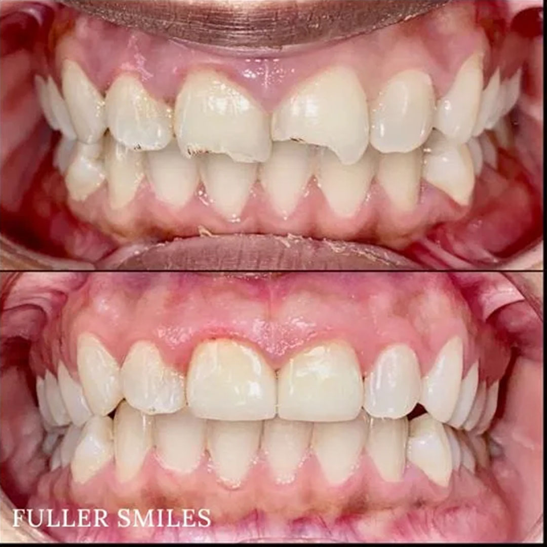 The image displays a side-by-side comparison of four different smiles with varying levels of tooth whitening, showcasing the results of a cosmetic dental treatment from a dentist named  FUller Smiles.
