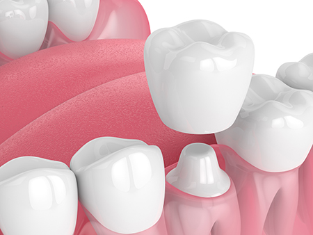 The image displays a close-up view of multiple artificial teeth and gums on a pink background, with each tooth having a distinct shape and color variation, suggesting a dental or oral health theme.