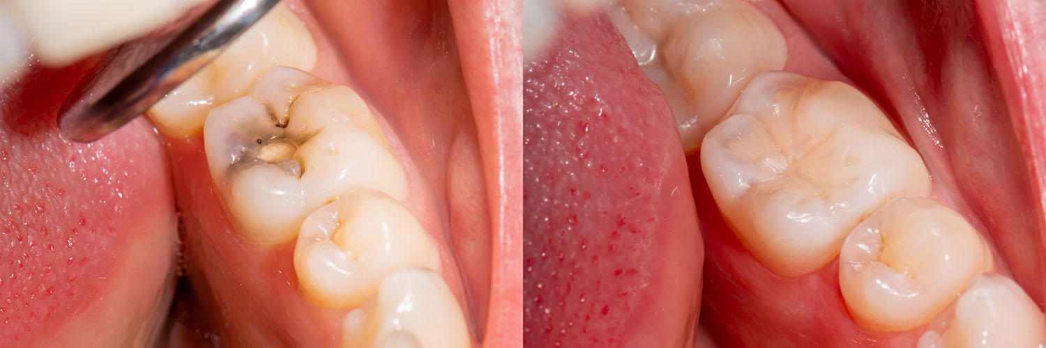 The image shows a close-up view of a person s teeth with visible signs of decay and damage, likely for dental health education or awareness purposes.